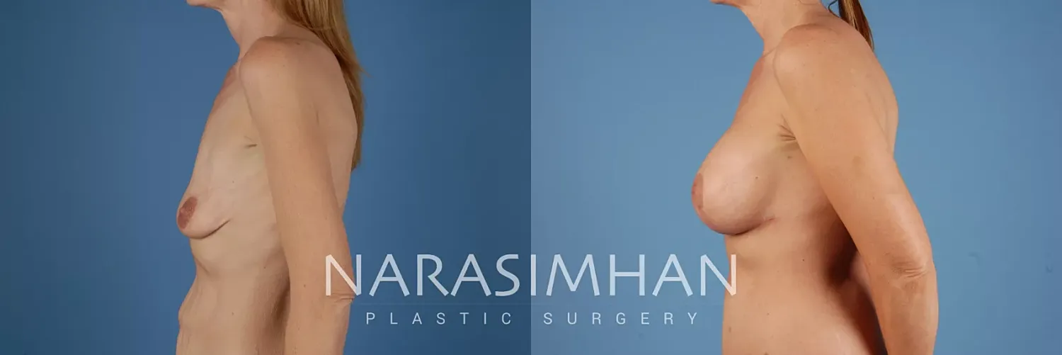 Breast Enhancement Before & After