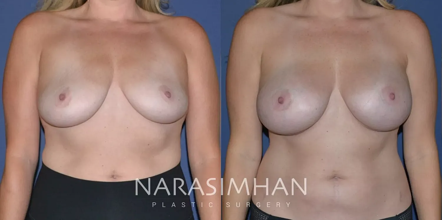 Breast Enhancement Before & After