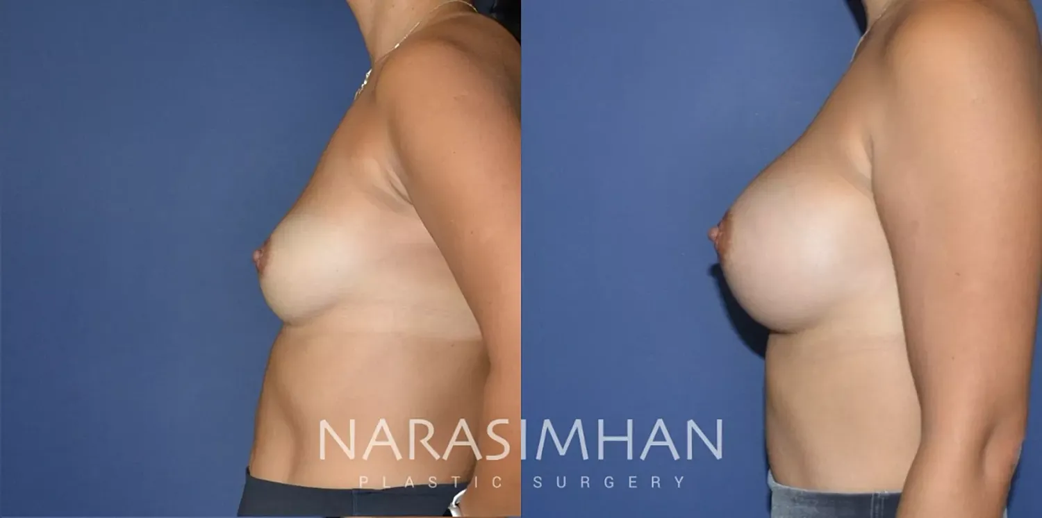 Breast Enhancement Before & After