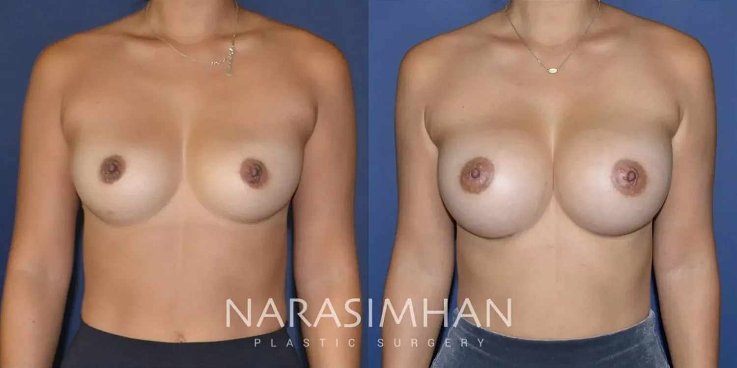 Breast Enhancement Before & After