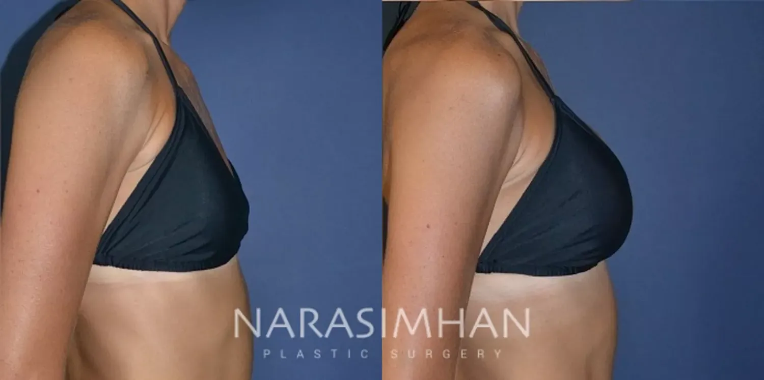 Breast Enhancement Before & After