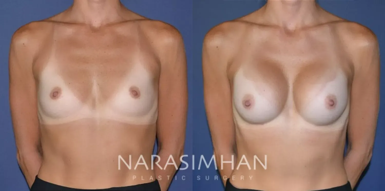 Breast Enhancement Before & After