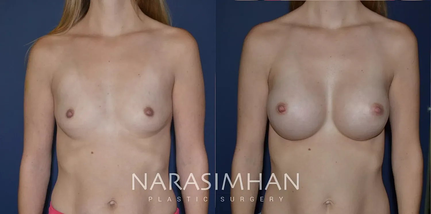 Breast Enhancement Before & After