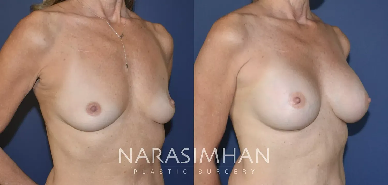 Breast Enhancement Before & After