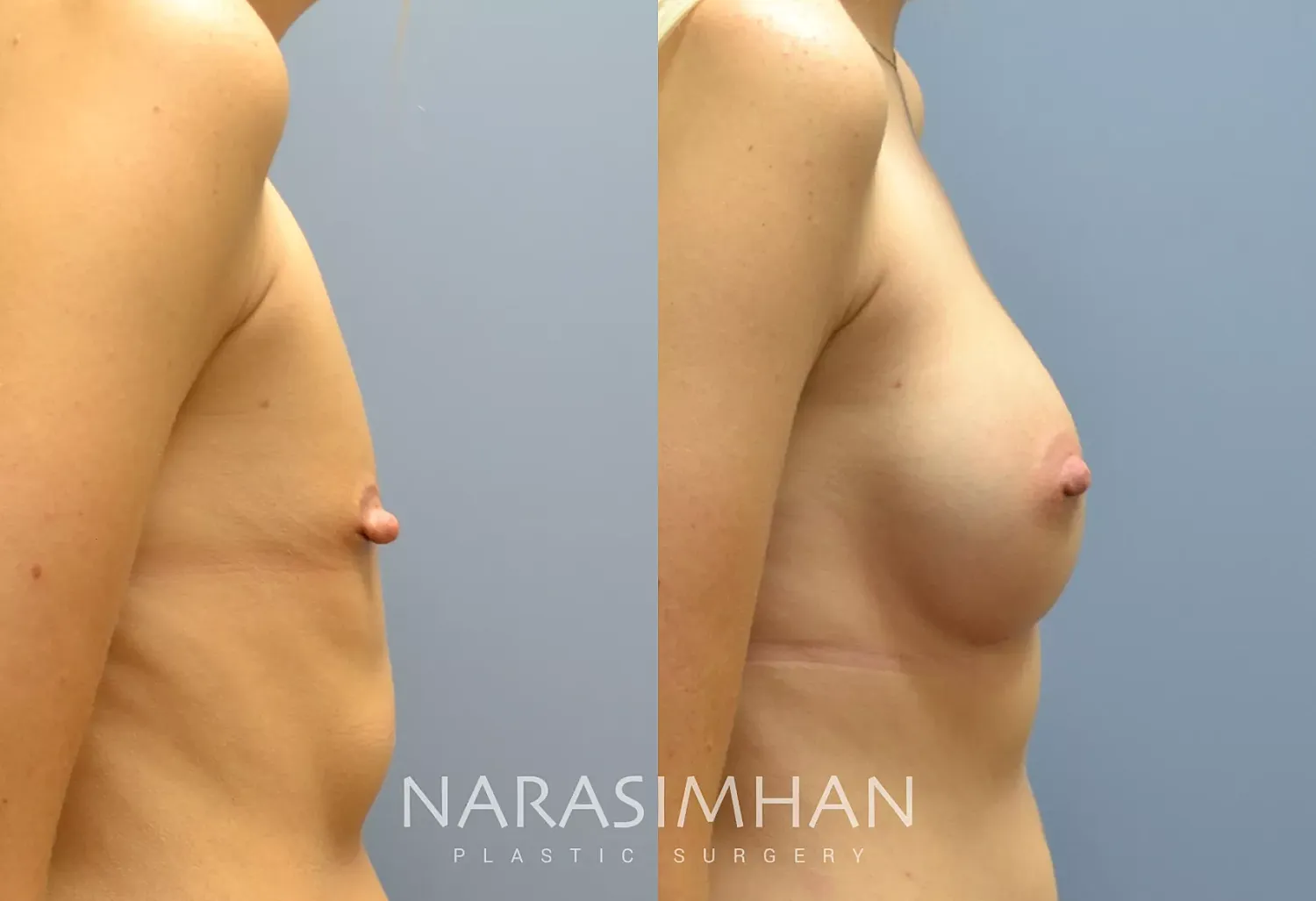 Breast Enhancement Before & After