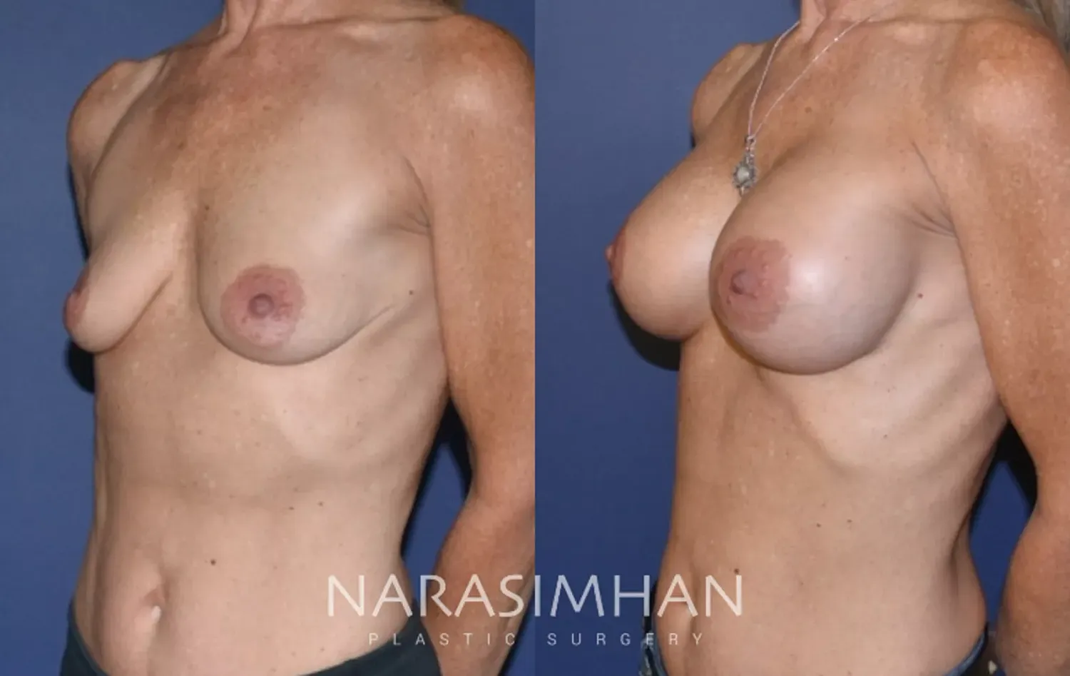 Breast Enhancement Before & After