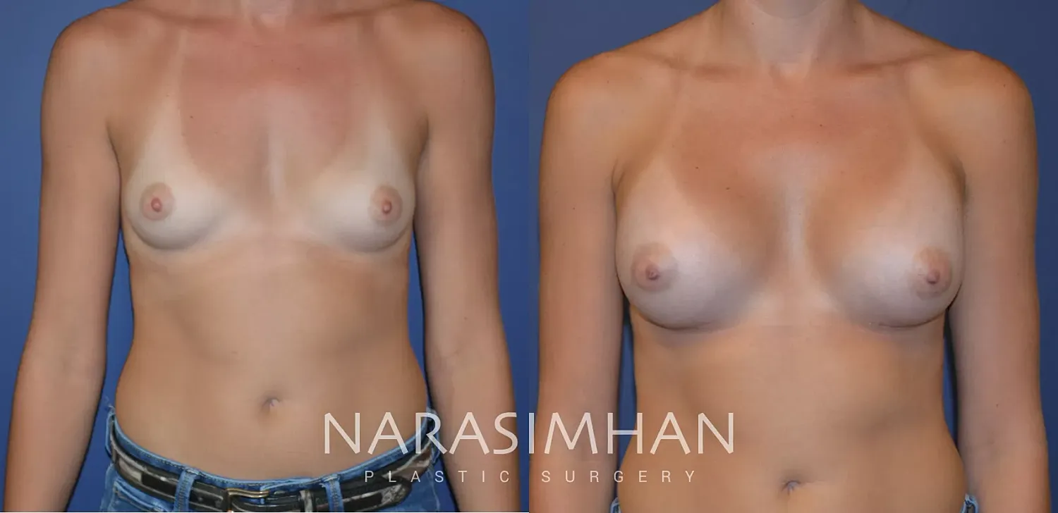 Breast Enhancement Before & After