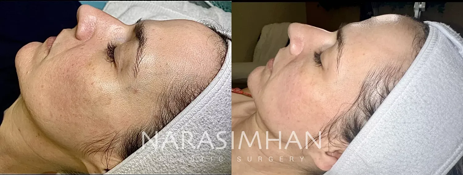 Bbl Moxi Before & After