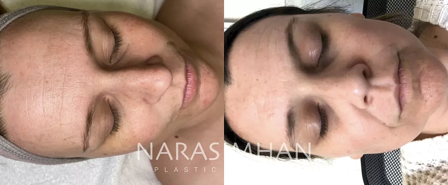 Bbl Moxi Before & After