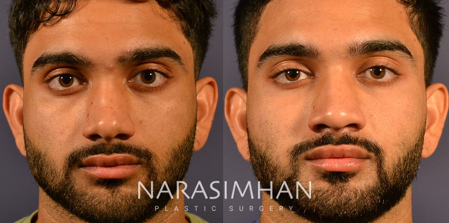 Facial Sculpting Before & After