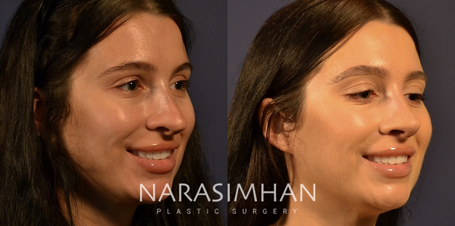Facial Sculpting Before & After