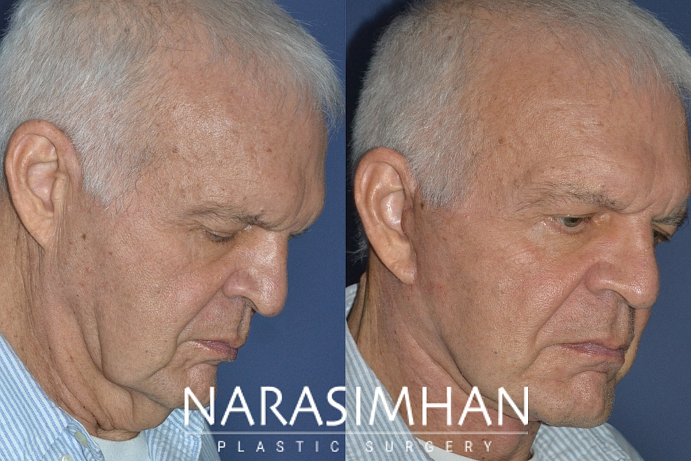 Facial Sculpting Before & After