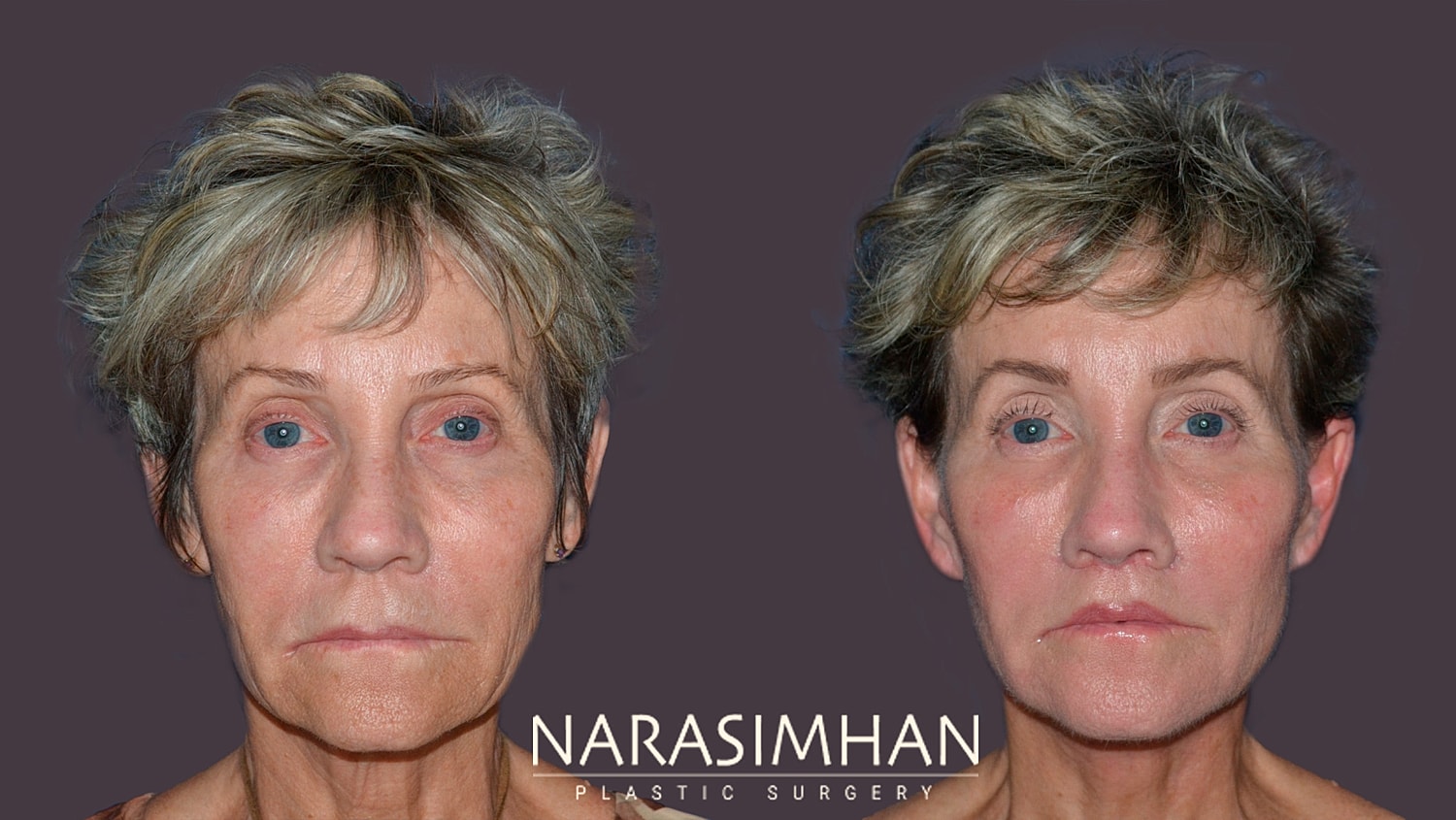 Facial Sculpting Before & After