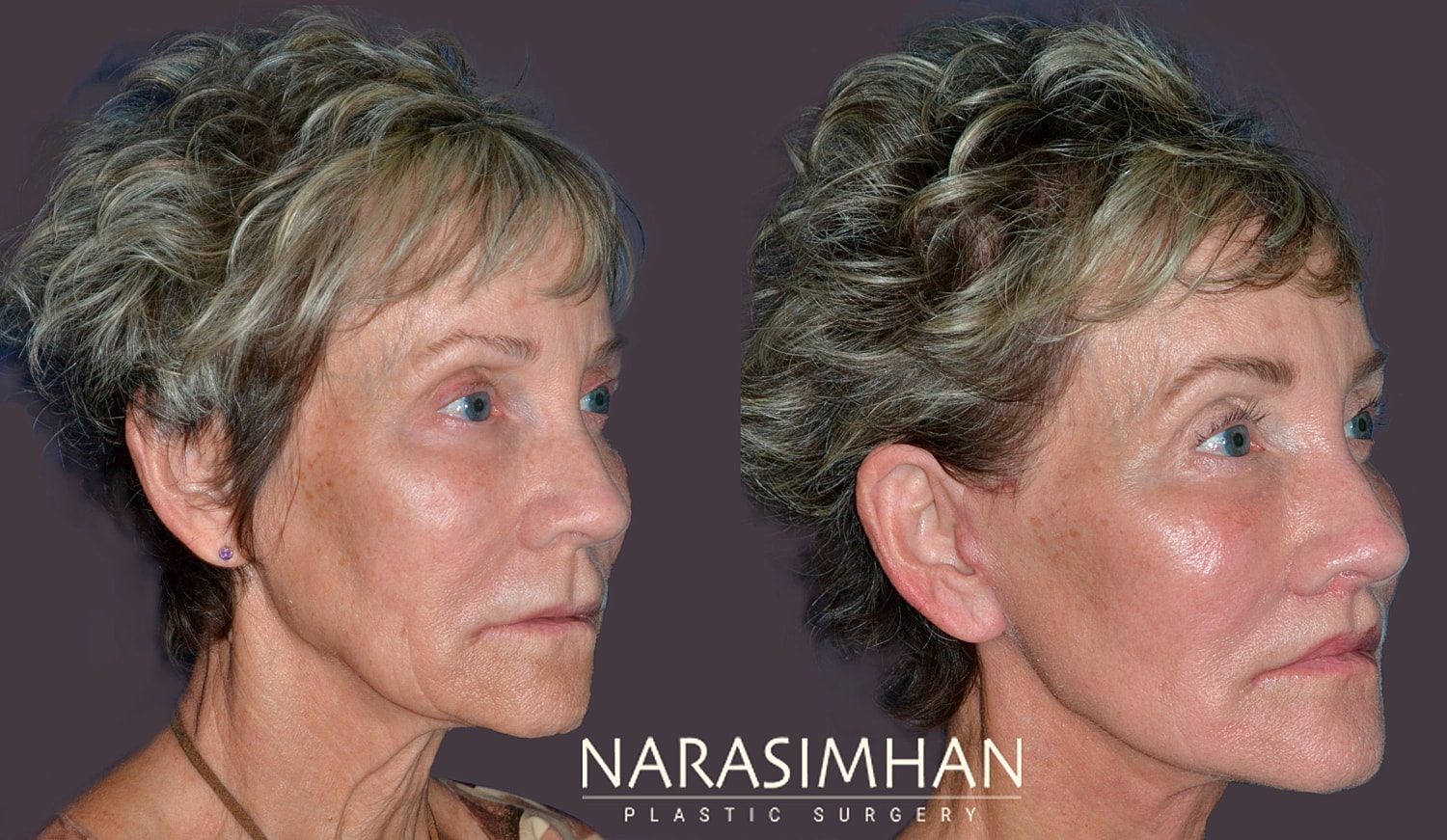 Facial Sculpting Before & After