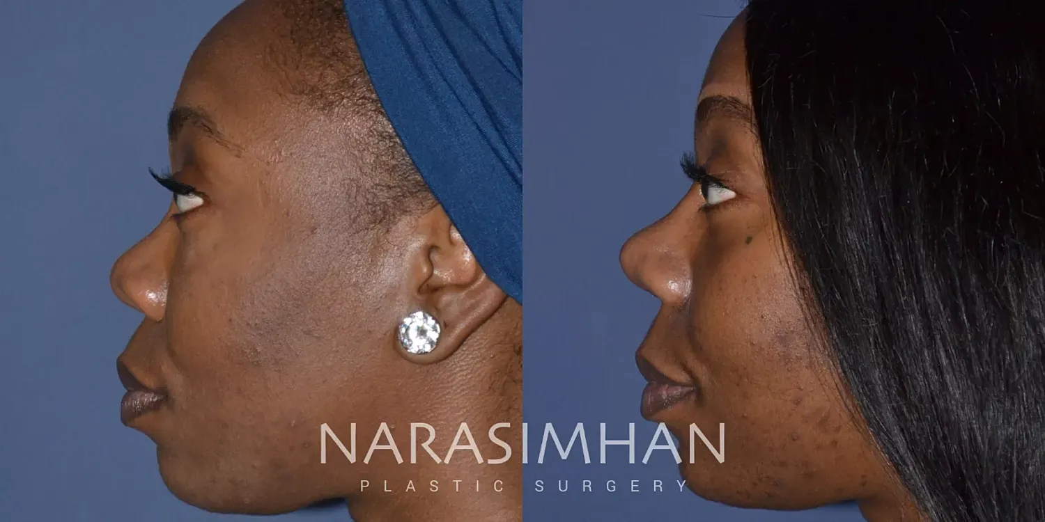 Facial Sculpting Before & After