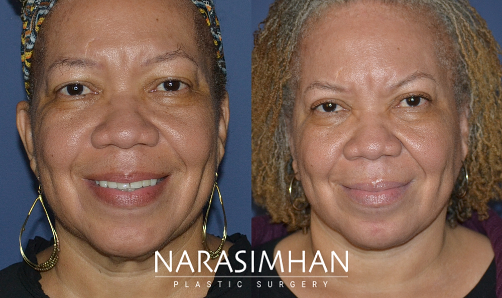 Facial Sculpting Before & After