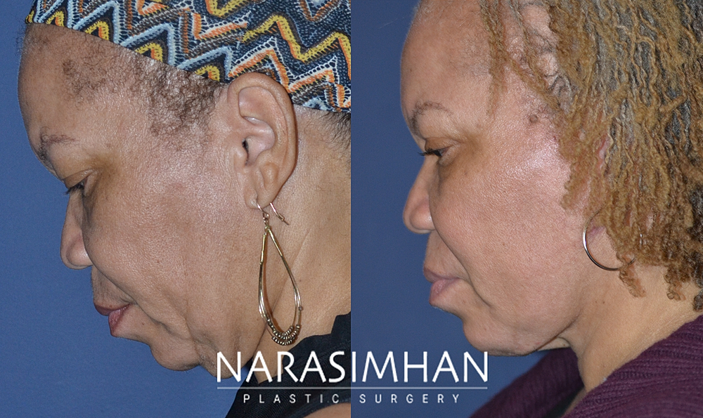 Facial Sculpting Before & After