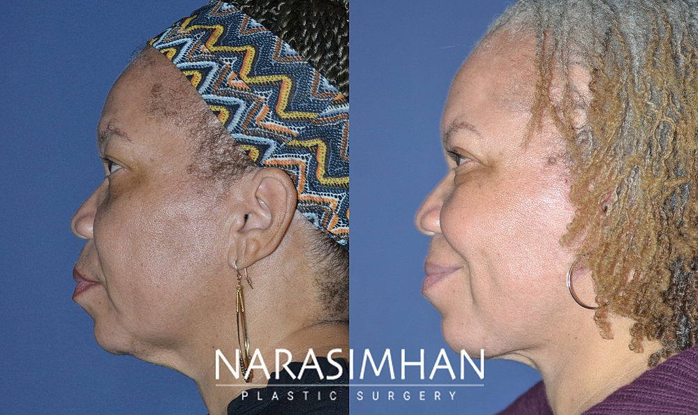 Facial Sculpting Before & After