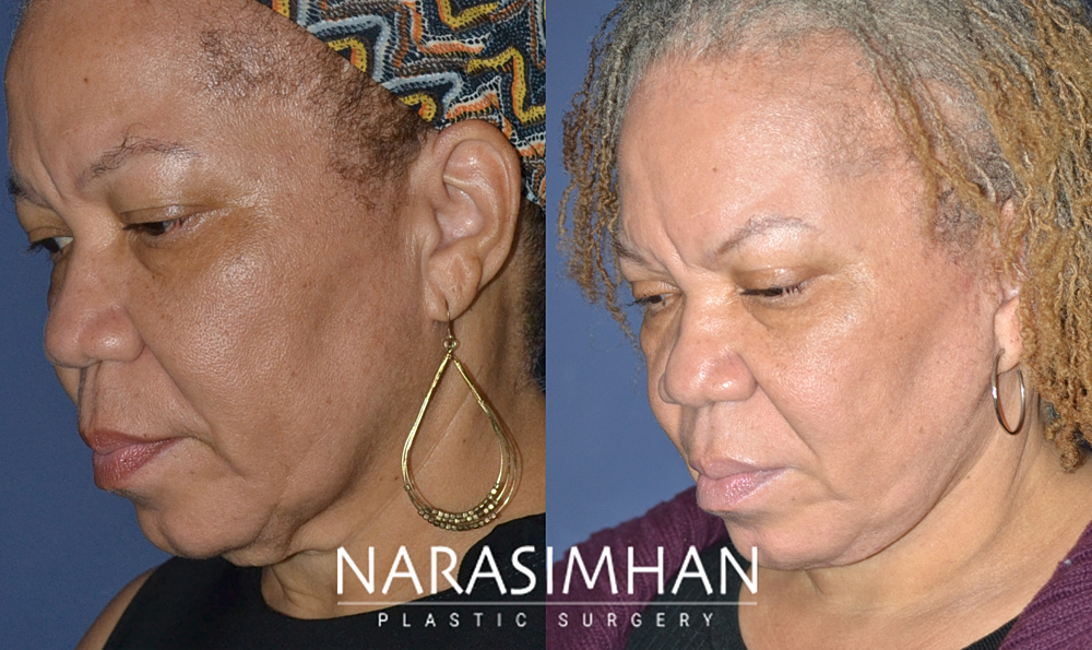 Facial Sculpting Before & After