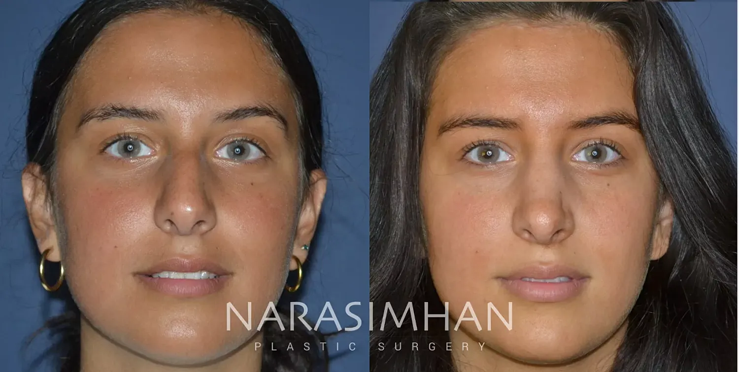 Facial Sculpting Before & After