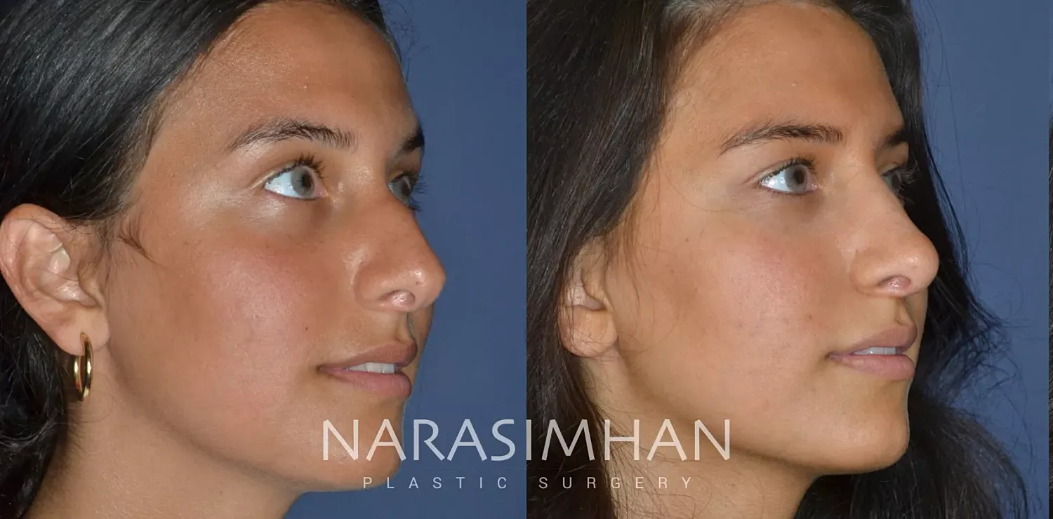 Facial Sculpting Before & After