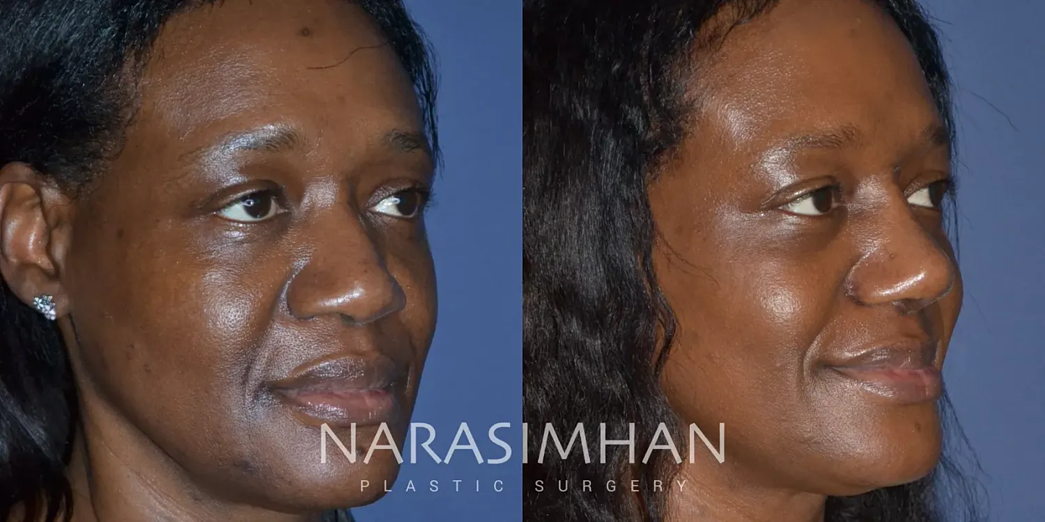 Facial Sculpting Before & After
