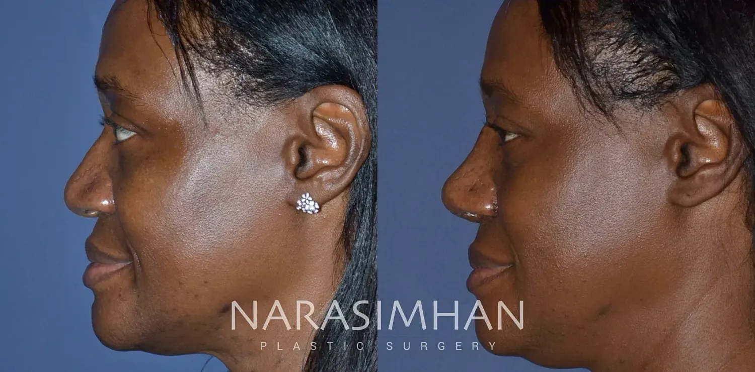 Facial Sculpting Before & After