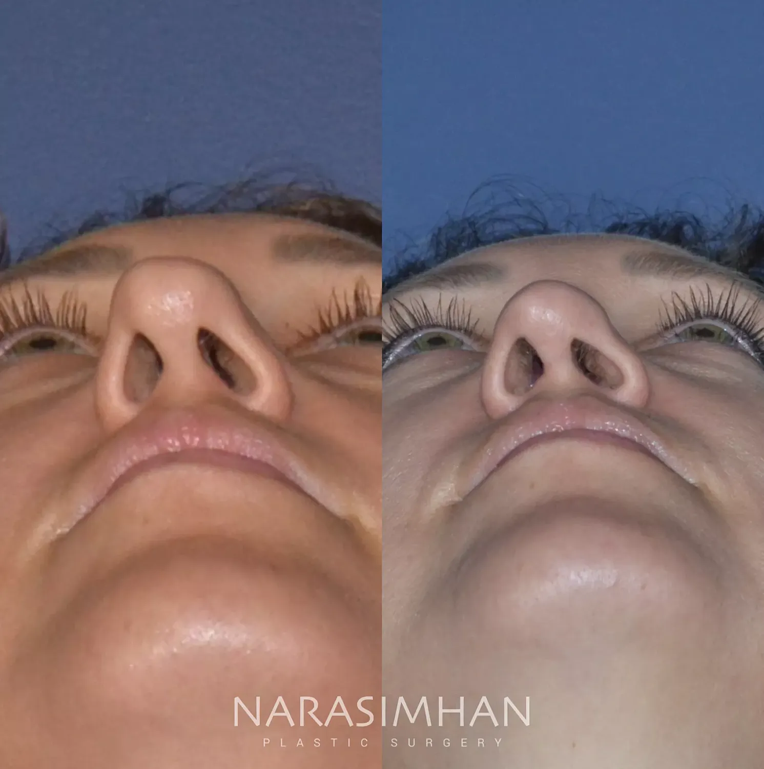 Facial Sculpting Before & After