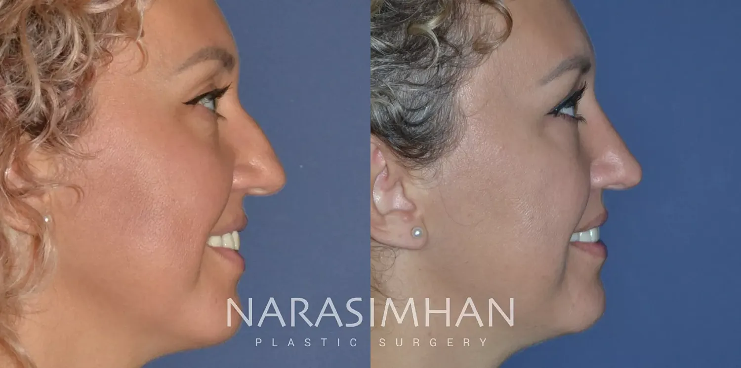 Facial Sculpting Before & After