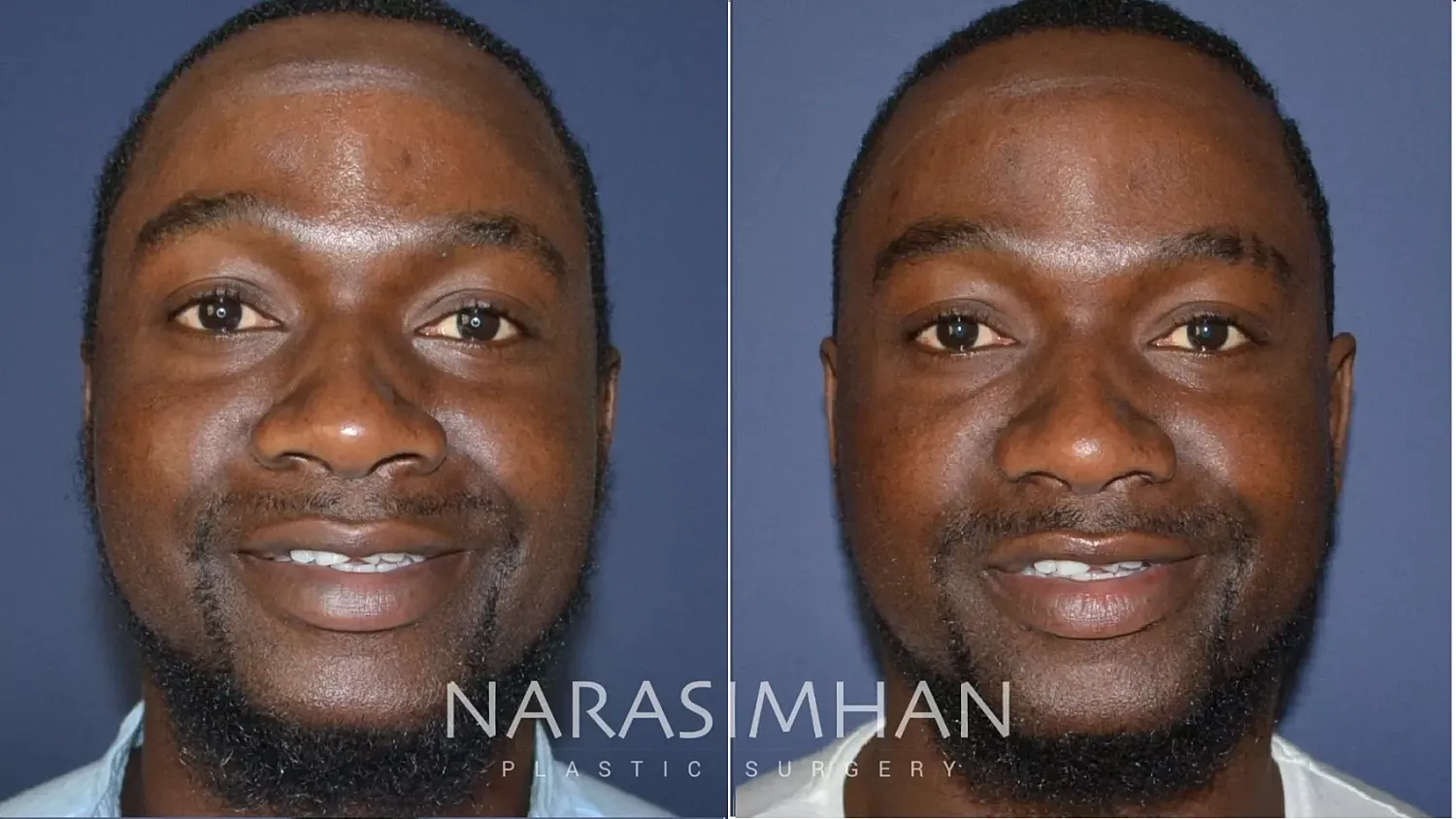 Facial Sculpting Before & After