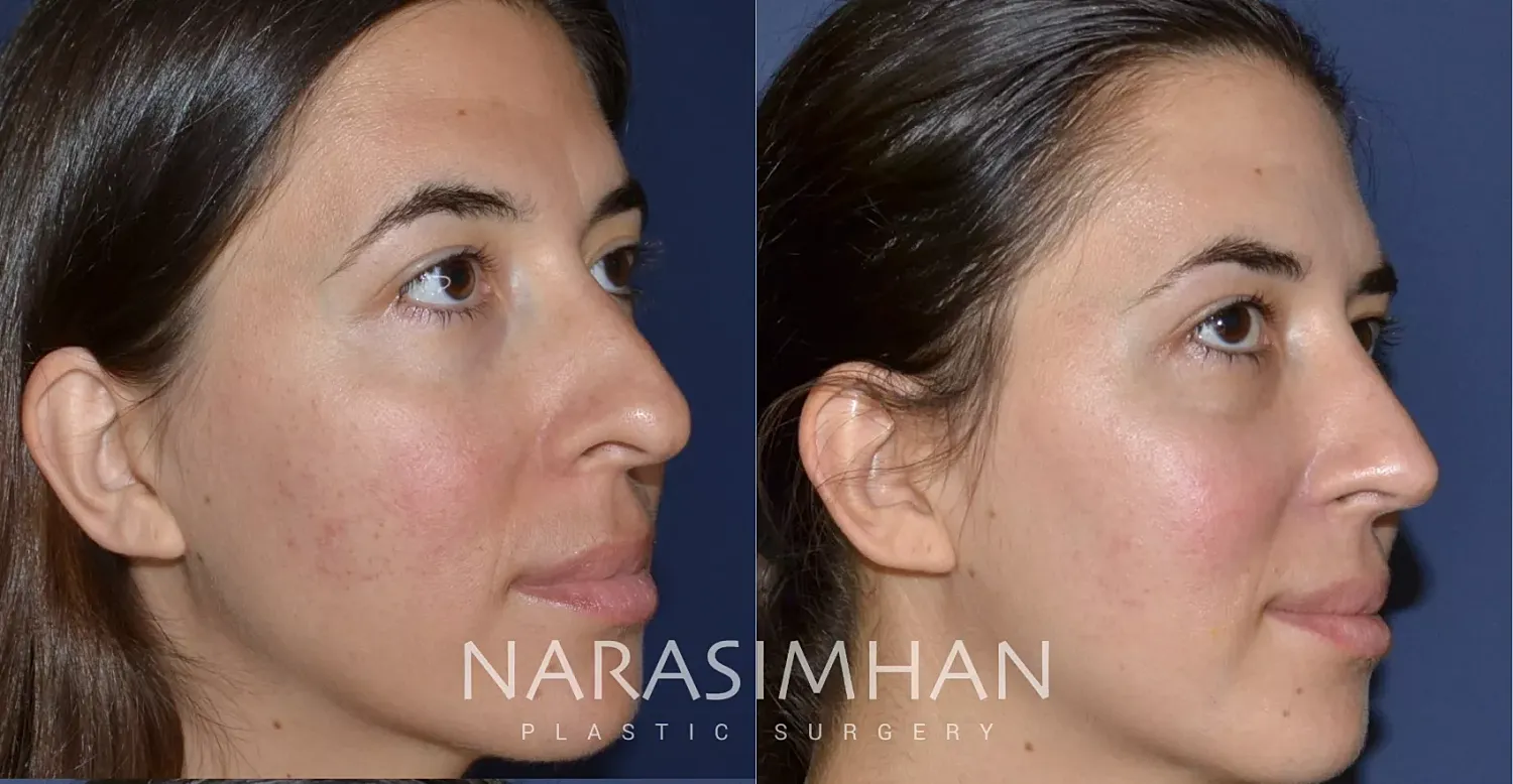 Facial Sculpting Before & After