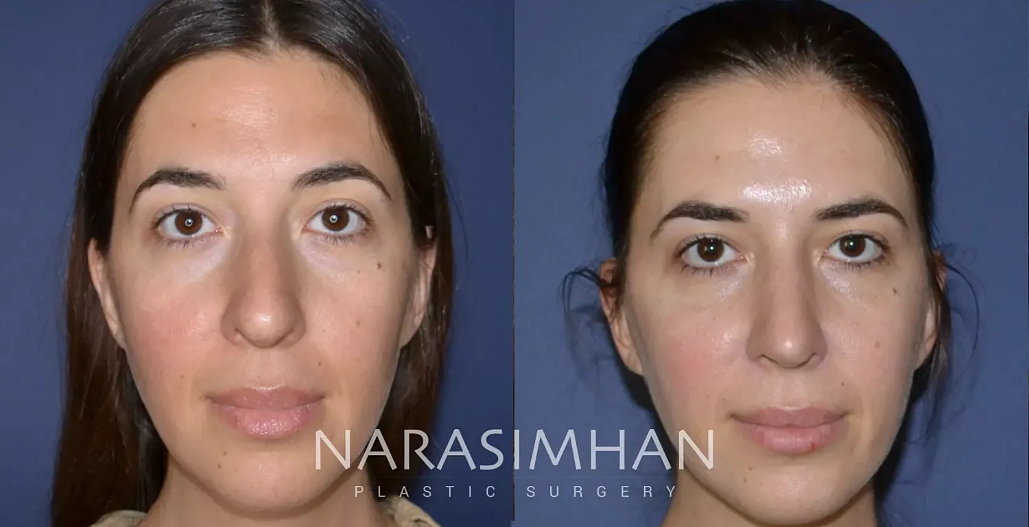 Facial Sculpting Before & After