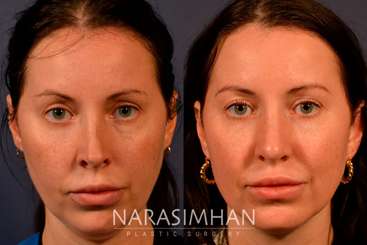 Facial Sculpting Before & After