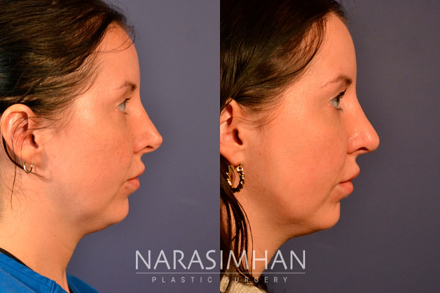 Facial Sculpting Before & After