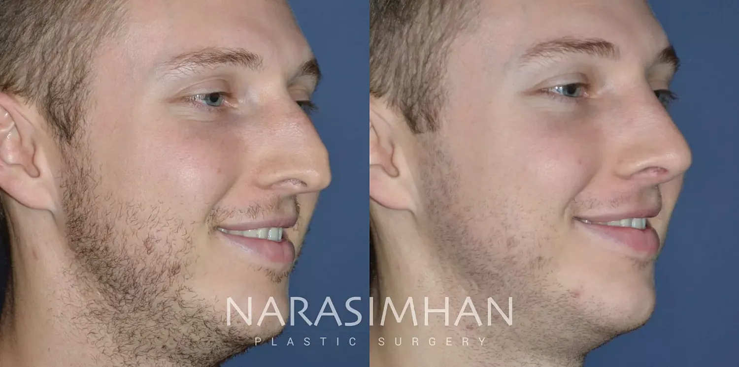 Facial Sculpting Before & After