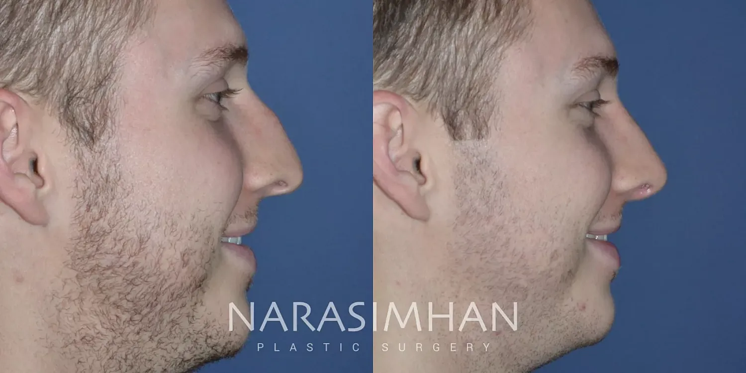 Facial Sculpting Before & After