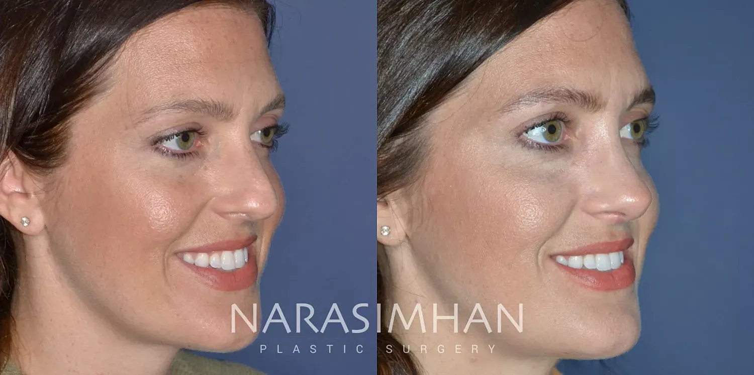 Facial Sculpting Before & After