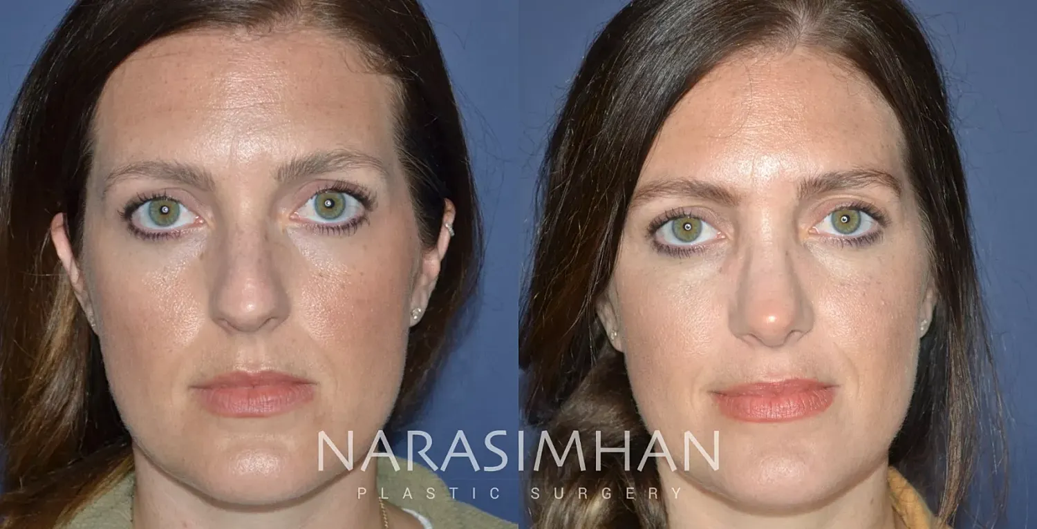Facial Sculpting Before & After