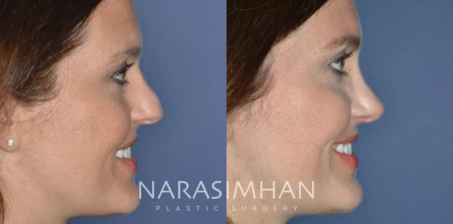 Facial Sculpting Before & After