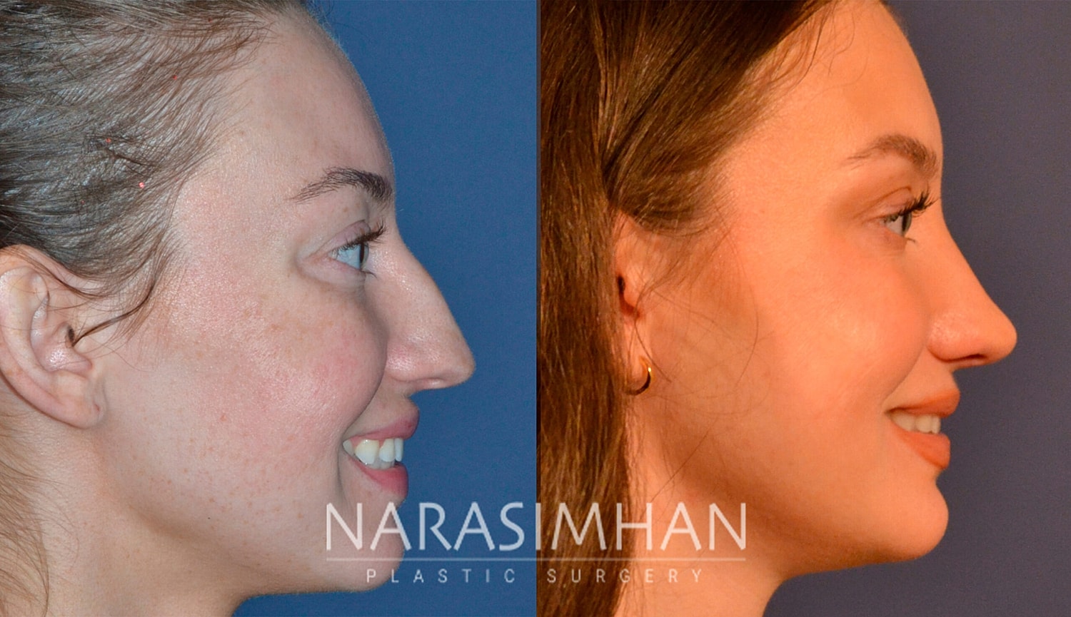 Facial Sculpting Before & After
