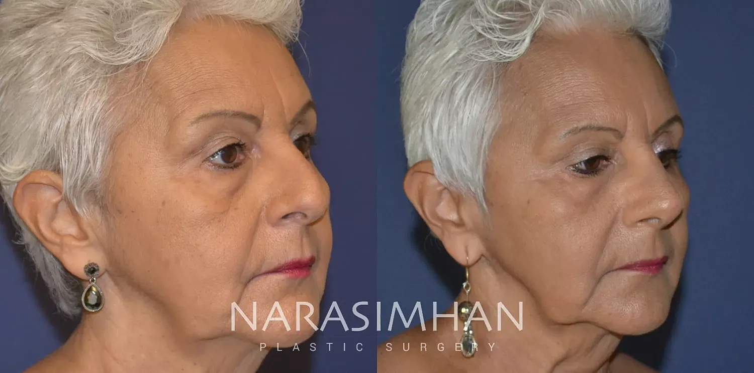 Facial Sculpting Before & After