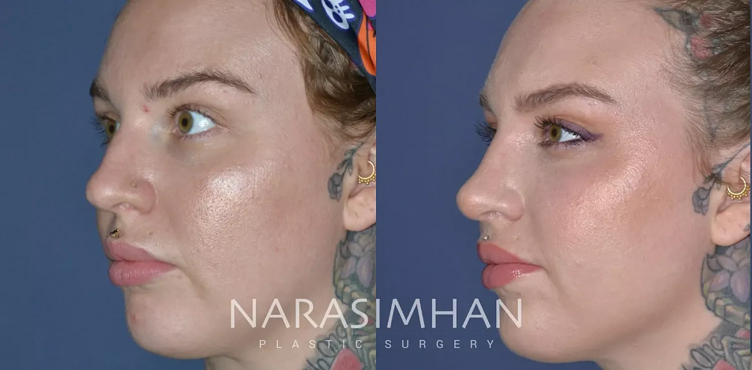 Facial Sculpting Before & After