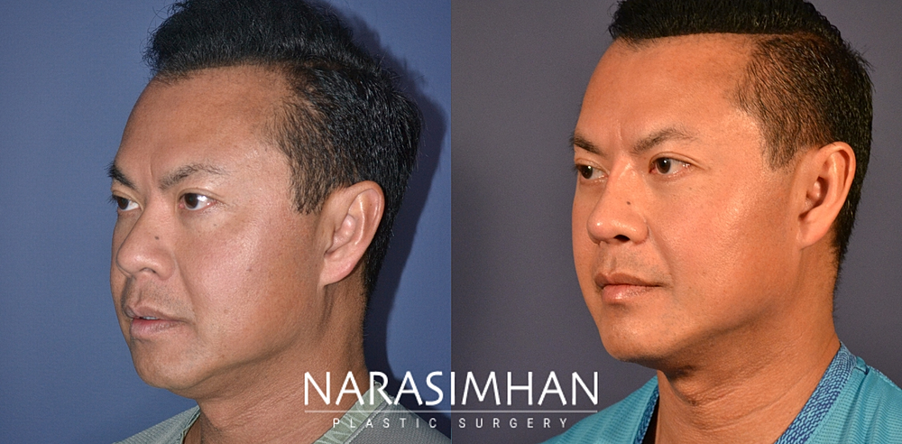 Facial Sculpting Before & After