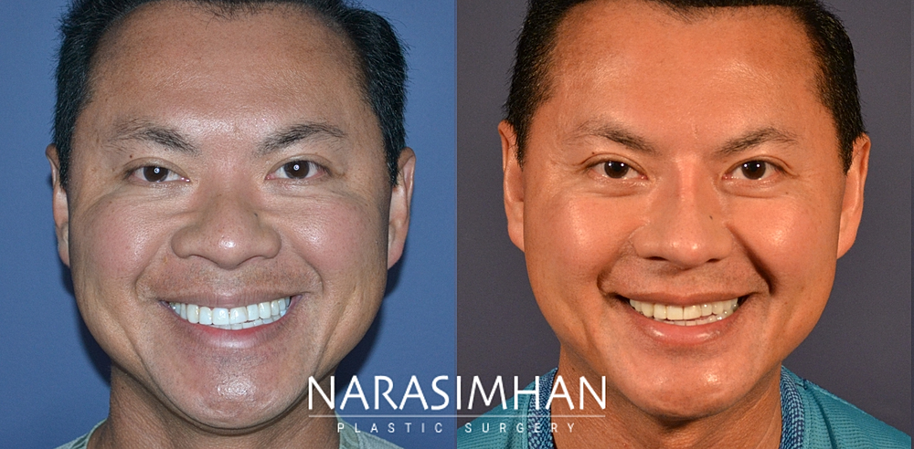 Facial Sculpting Before & After