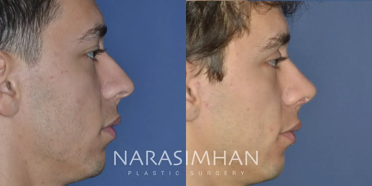 Facial Sculpting Before & After