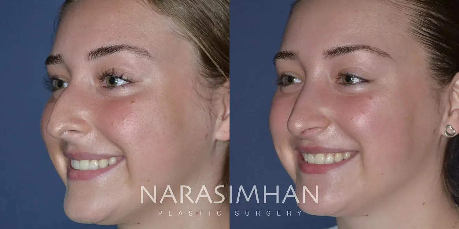 Facial Sculpting Before & After