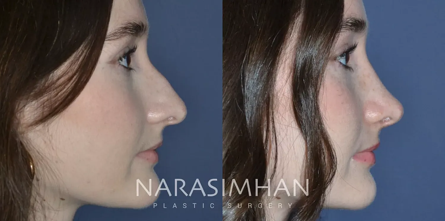 Facial Sculpting Before & After