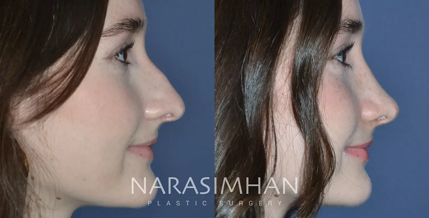 Facial Sculpting Before & After