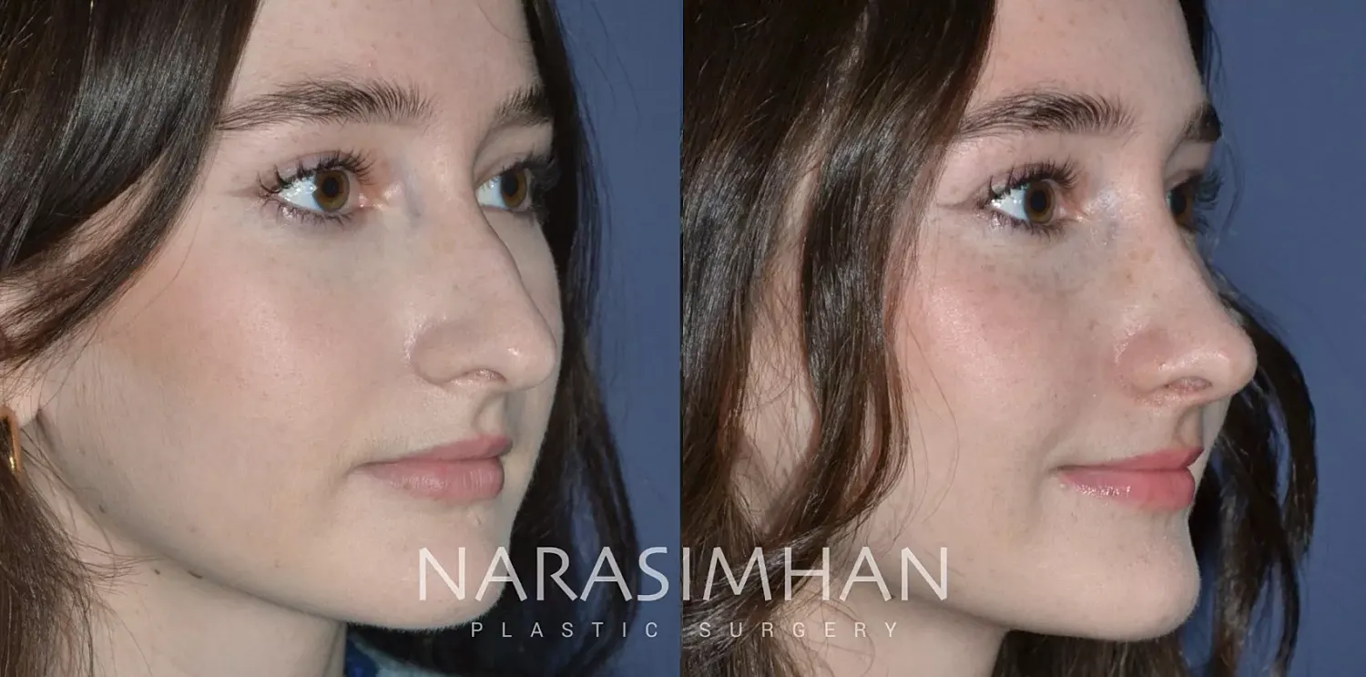 Facial Sculpting Before & After