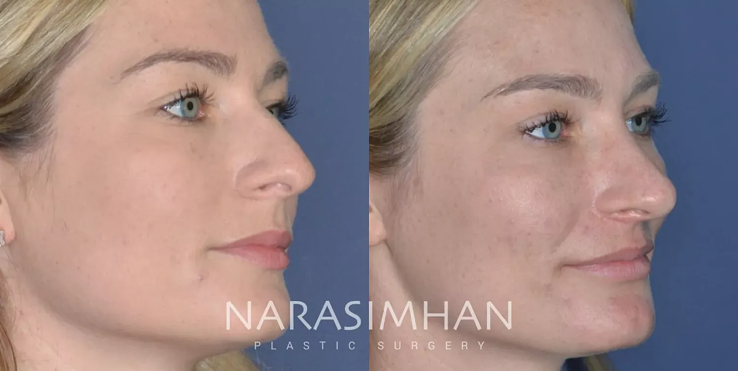 Facial Sculpting Before & After
